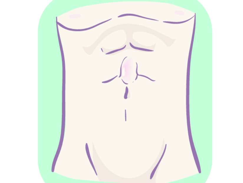腹壁瘢痕ヘルニア