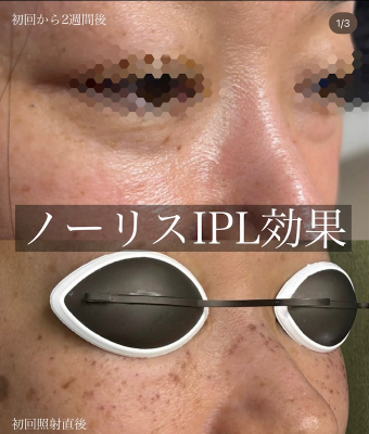 IPL効果_画像.01