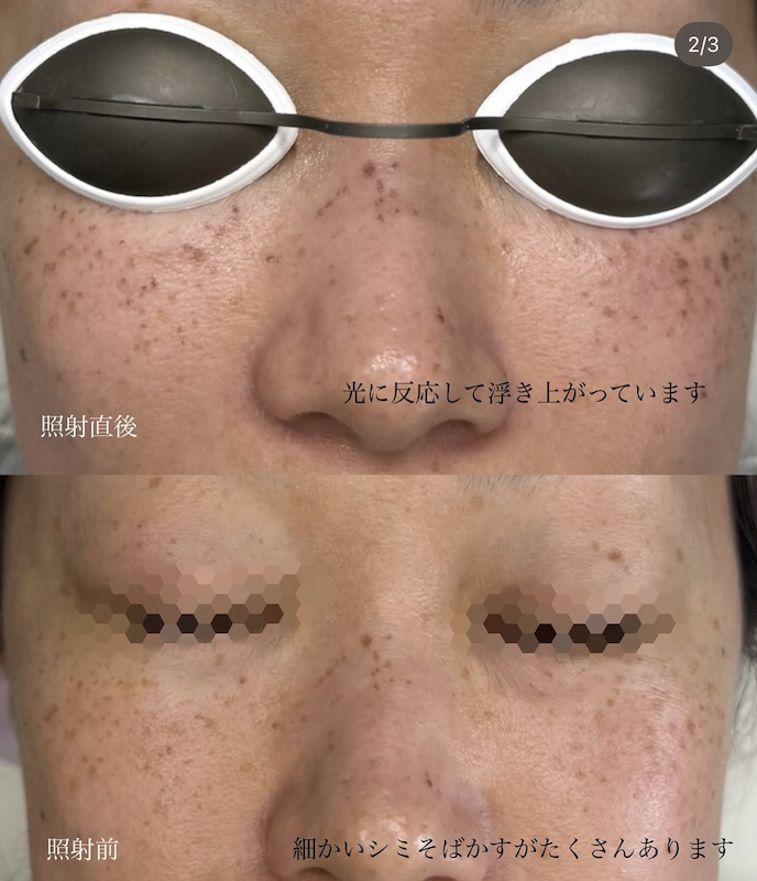 IPL効果_画像.02