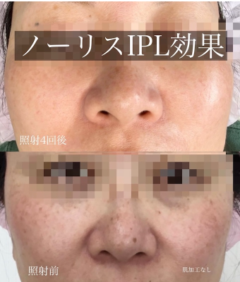 IPL効果_画像.05