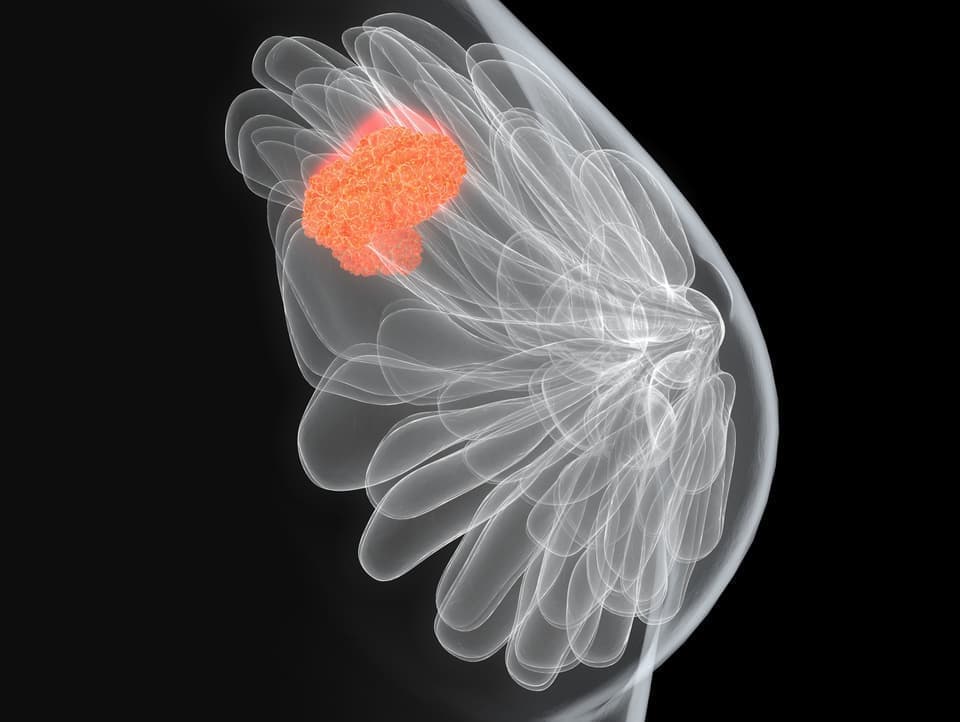 乳腺繊維腺腫のイラスト