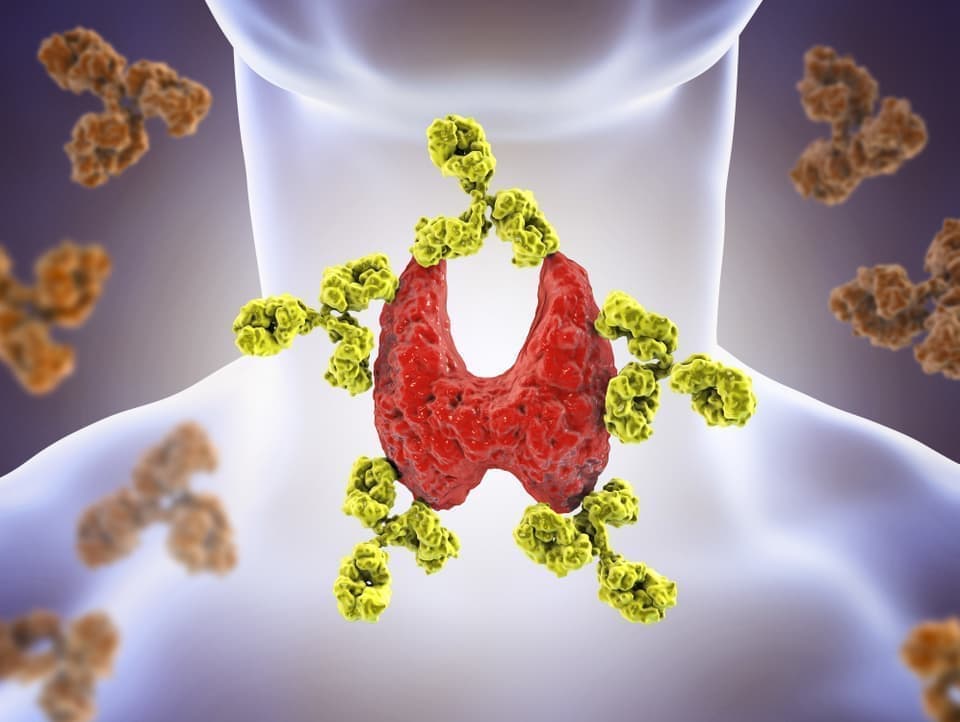 橋本病のイラスト