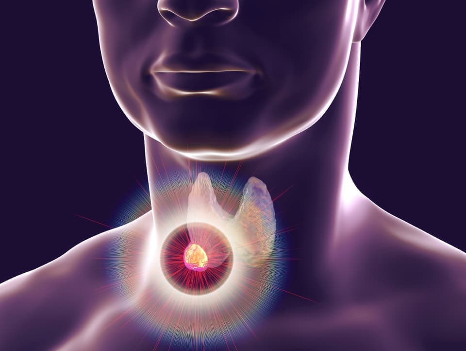 甲状腺がんのイラスト